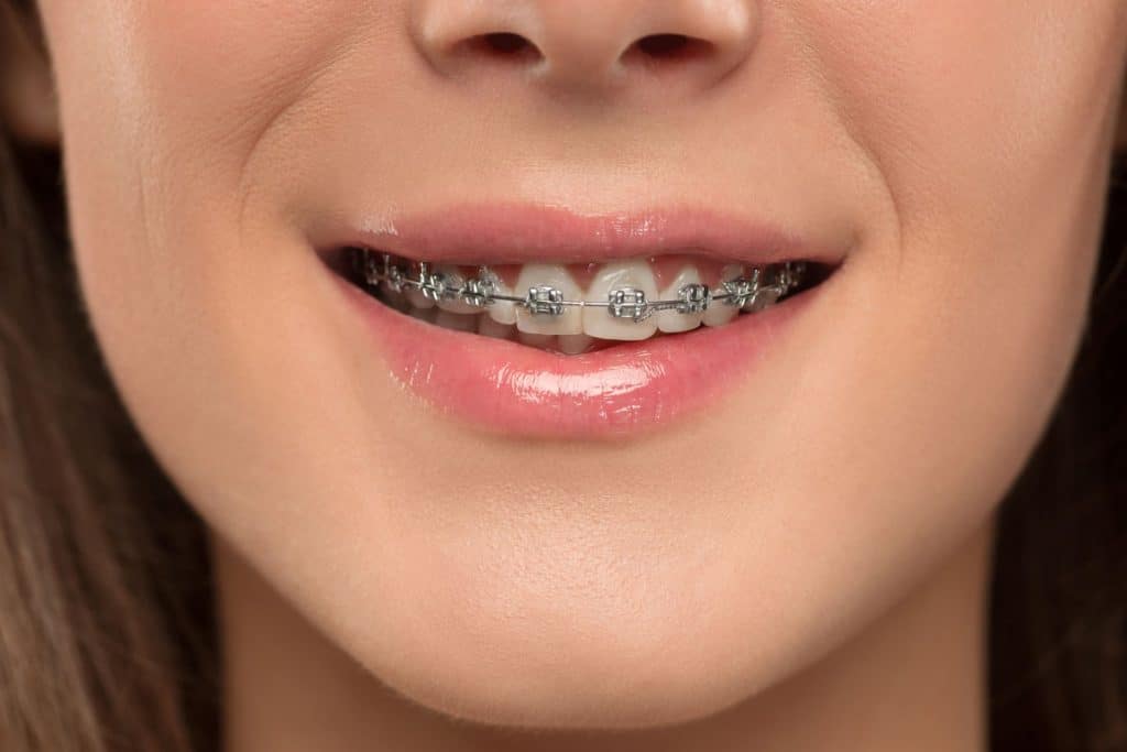 Orthodontist Teeth Braces Brisbane Springwood