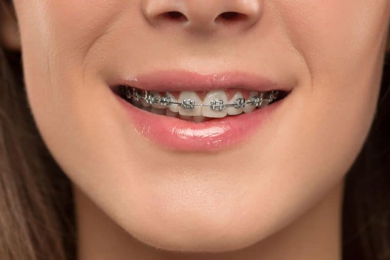 Orthodontist Brisbane Orthodontics & Braces