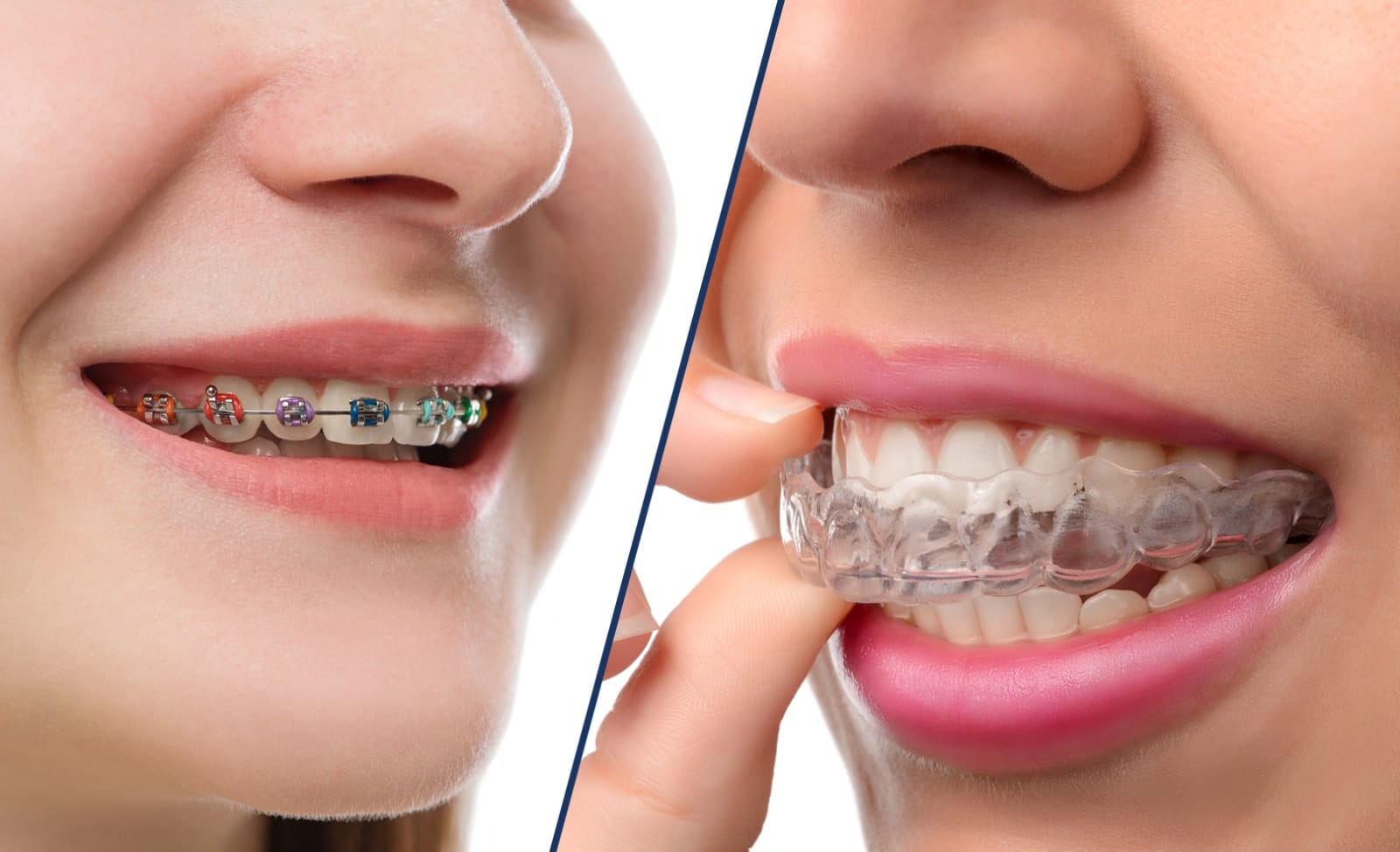 Braces Vs Invisalign Which Is Better For You